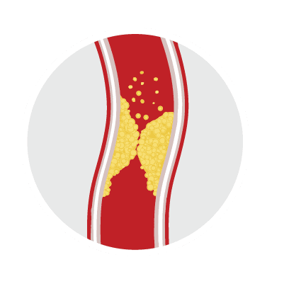 Zamašena arterija